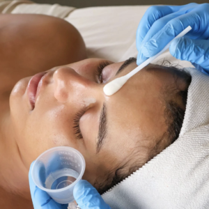 Chemical Peel