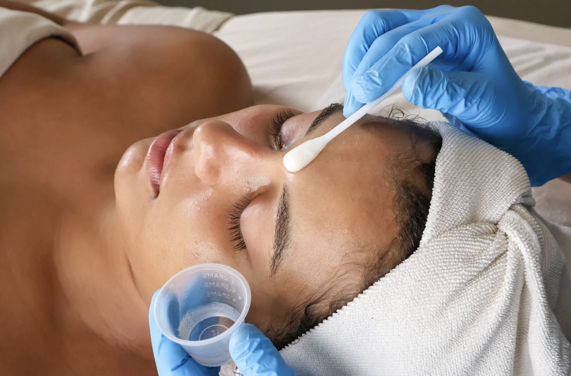 Chemical Peel